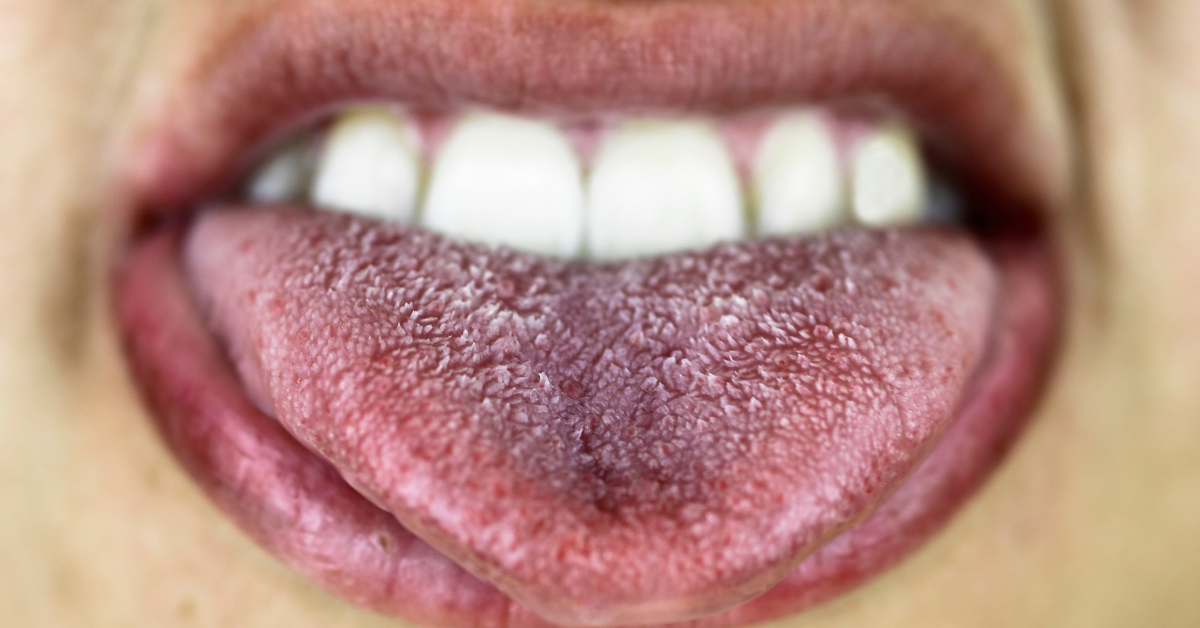 A szájüregi rák, szájrák jelei - Milyen a nyelvrák?