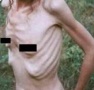 Anorexia hatéves korban: hogy lehet megállítani?