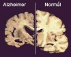 Nagyszabású génelemzéssel az Alzheimer-kór ellen