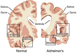 Az étvágyat szabályozó hormon összefügghet az Alzheimer-kórral